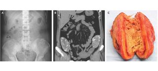 sponges, nejm