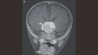 brain scan of an infant's head with small white arrows pointing to a tumor