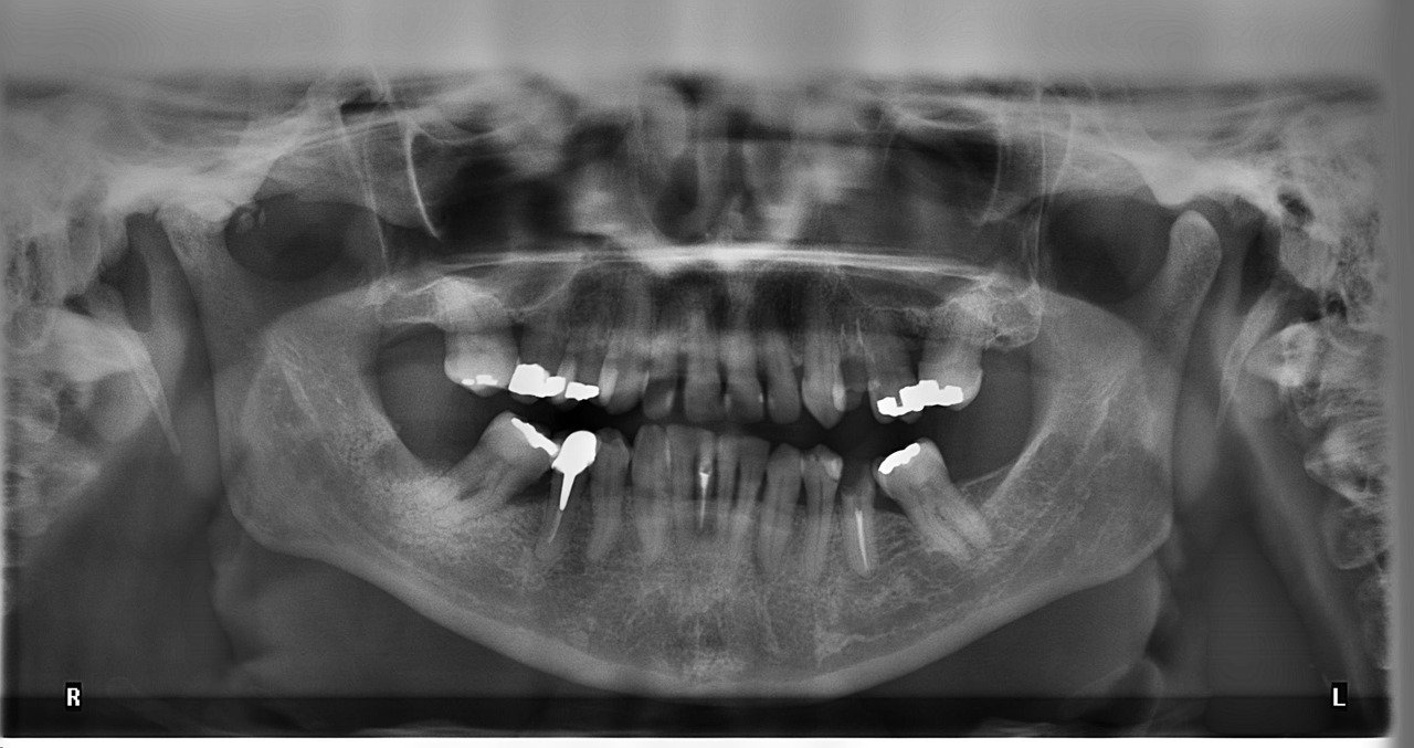 Dental X-Ray