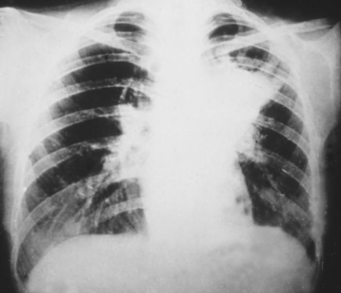 An x-ray of a person&#039;s lungs showing signs of infection