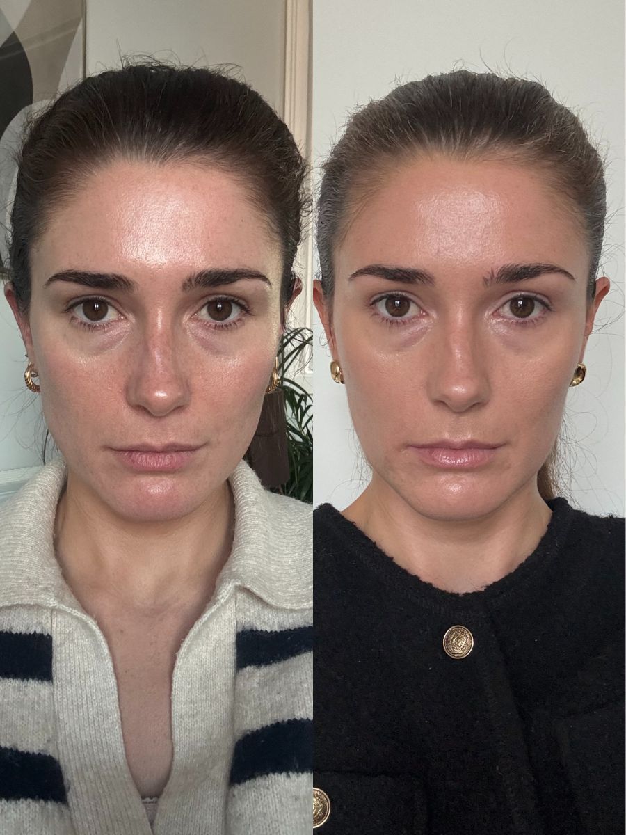 Tratamiento de cejas Sofwave antes y después de 3 meses