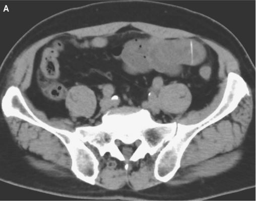 A fish bone pierced a hole through a man&#039;s intestine. Above, an X-ray showing the fish bone in the man&#039;s gut, in the upper right corner of the image. 