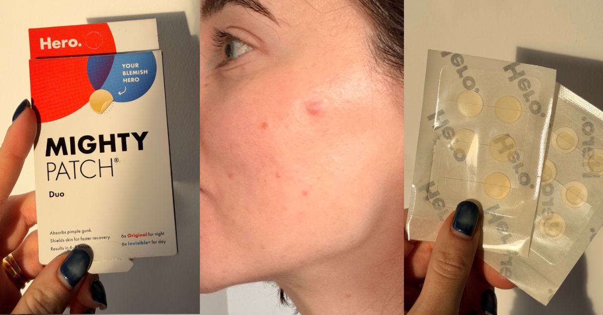I Tested the Internet’s Most-Loved Spot Patches—Here’s Why They’re Worth the Hype