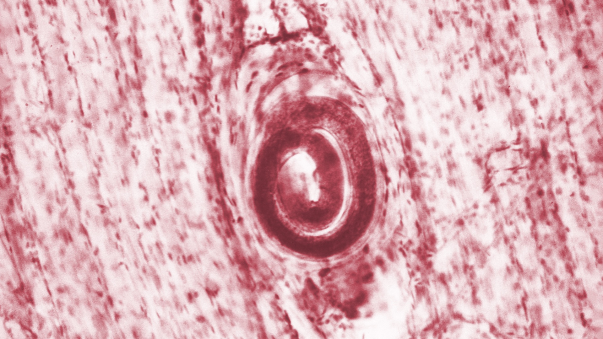a photomicrograph depicting a Trichinella spiralis cyst, that was embedded in a muscle tissue specimen