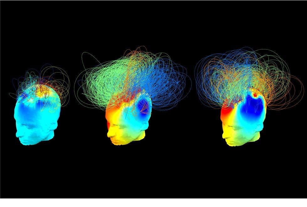 These are brain networks in two vegetative patients (left and middle), alongside a healthy adult (right). The vegetative patients appeared behaviorally similar but one of them (middle) showed signs of hidden awareness during a previous fMRI study.