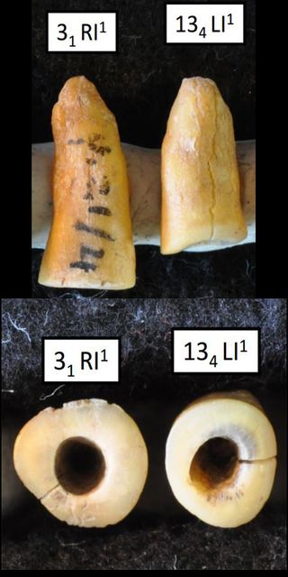 The teeth are perhaps the oldest known examples of tooth-filling, the researchers said.