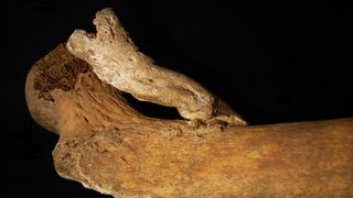 A picture of the femur bone with the 3-inch bone growth.
