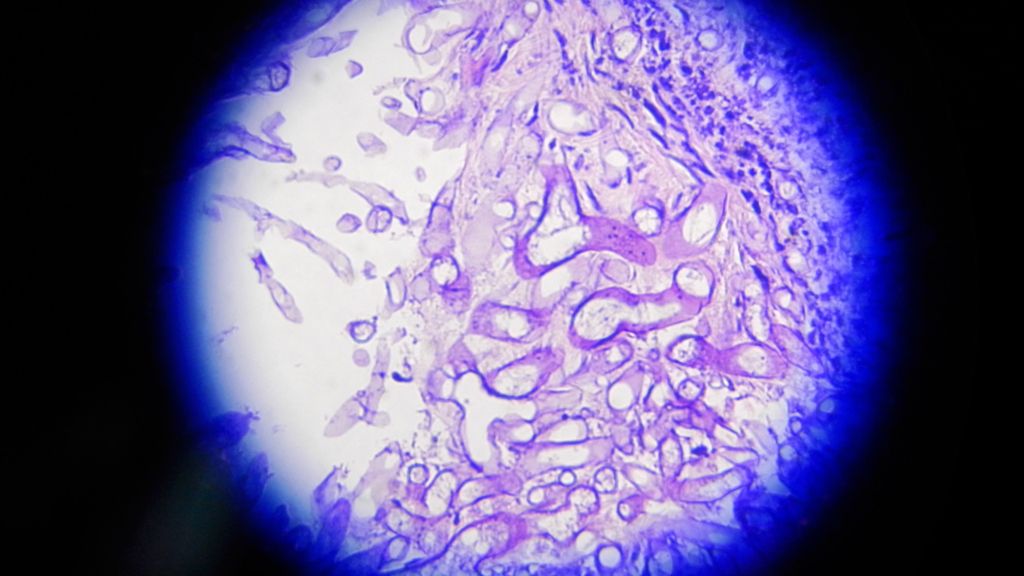 Microscopic image of a mucormycosis fungal infection