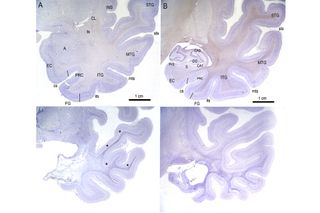 These higher-magnification photomicrographs show stained sections of the medial temporal lobe of EP (lower) and a control subject (upper), including the amygdaloid complex (A) and the hippocampal formation (B), both involved in memory and emotion. In both regions, EP’s brain shows dramatic shrinkage of white matter and scarring.
