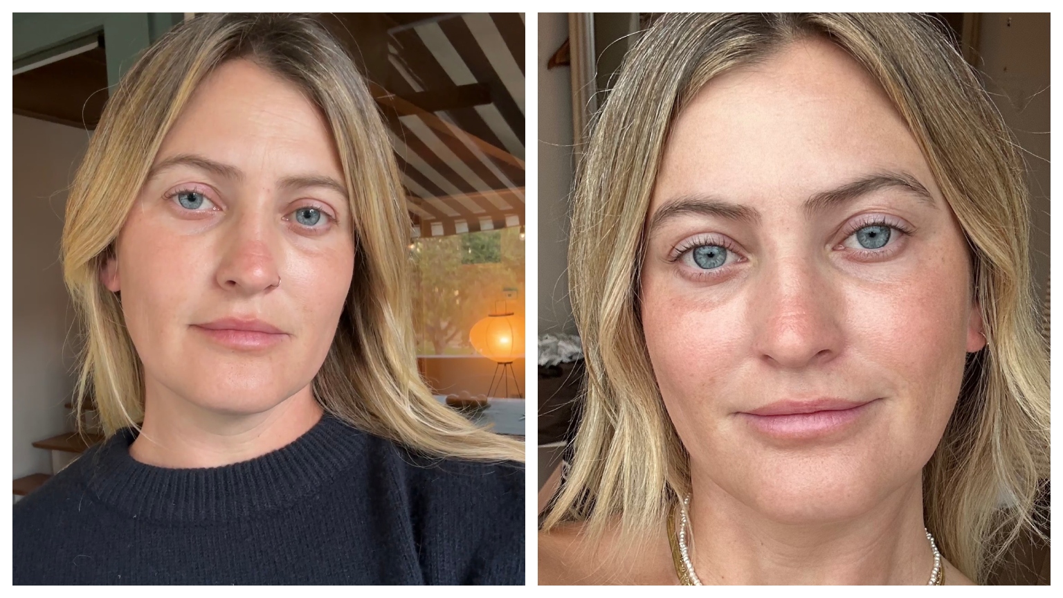 side by side photos of Aviel Kanter before and after a brow lift