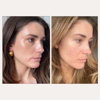 Before and after radiofrequency microneedling