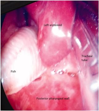 An image shows what that catfish looked like in the man's throat prior to removal.