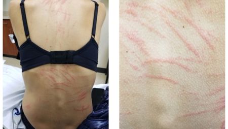 Two photos showing a close up of a woman's back, with a series of red, claw-like marks across her skin