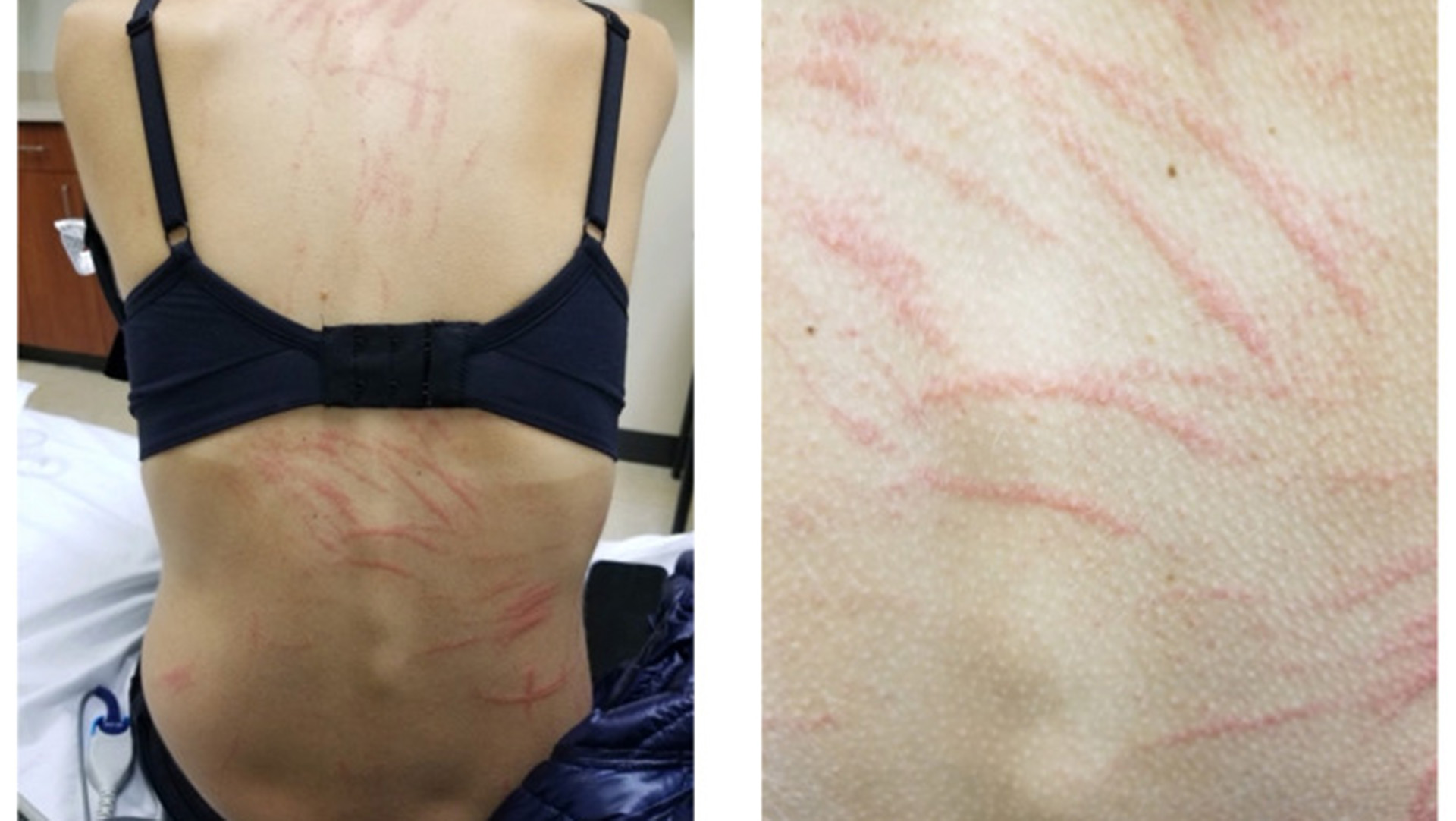 Two photos showing a close up of a woman's back, with a series of red, claw-like marks across her skin