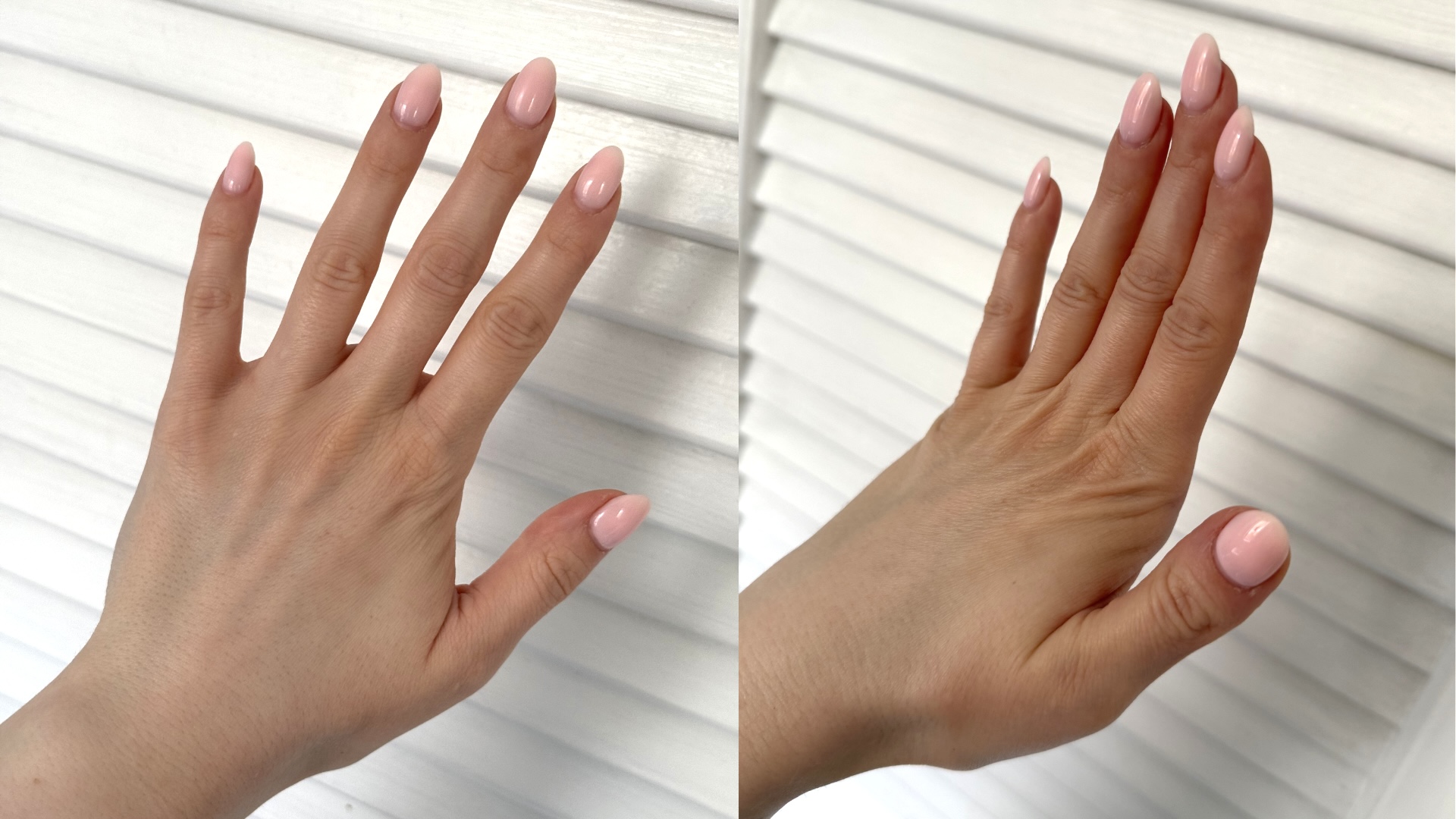 Two images of Lucy's hands before treatment