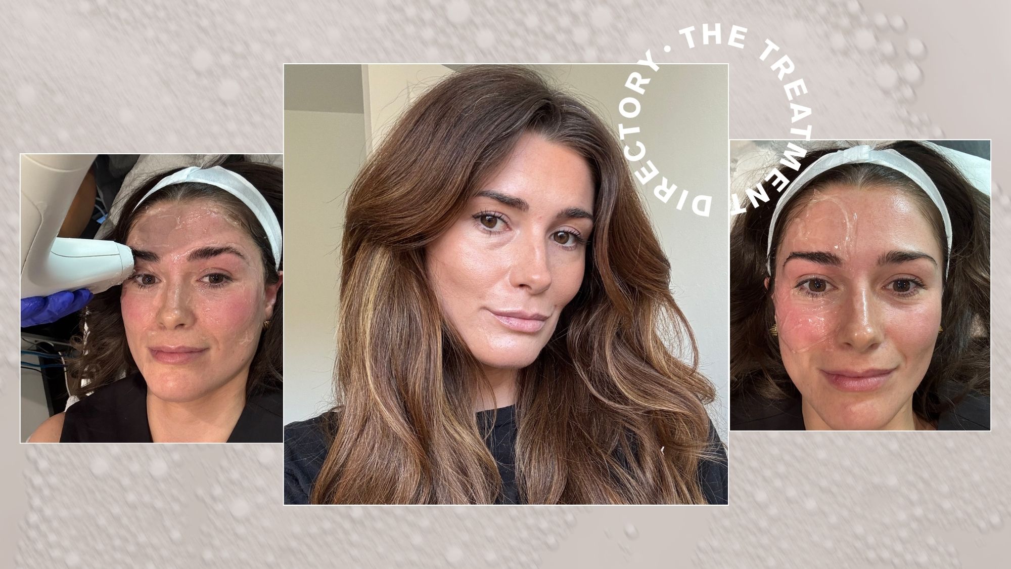 A collage of beauty editor Eleanor Vousden testing the Sofwave treatment on her brows