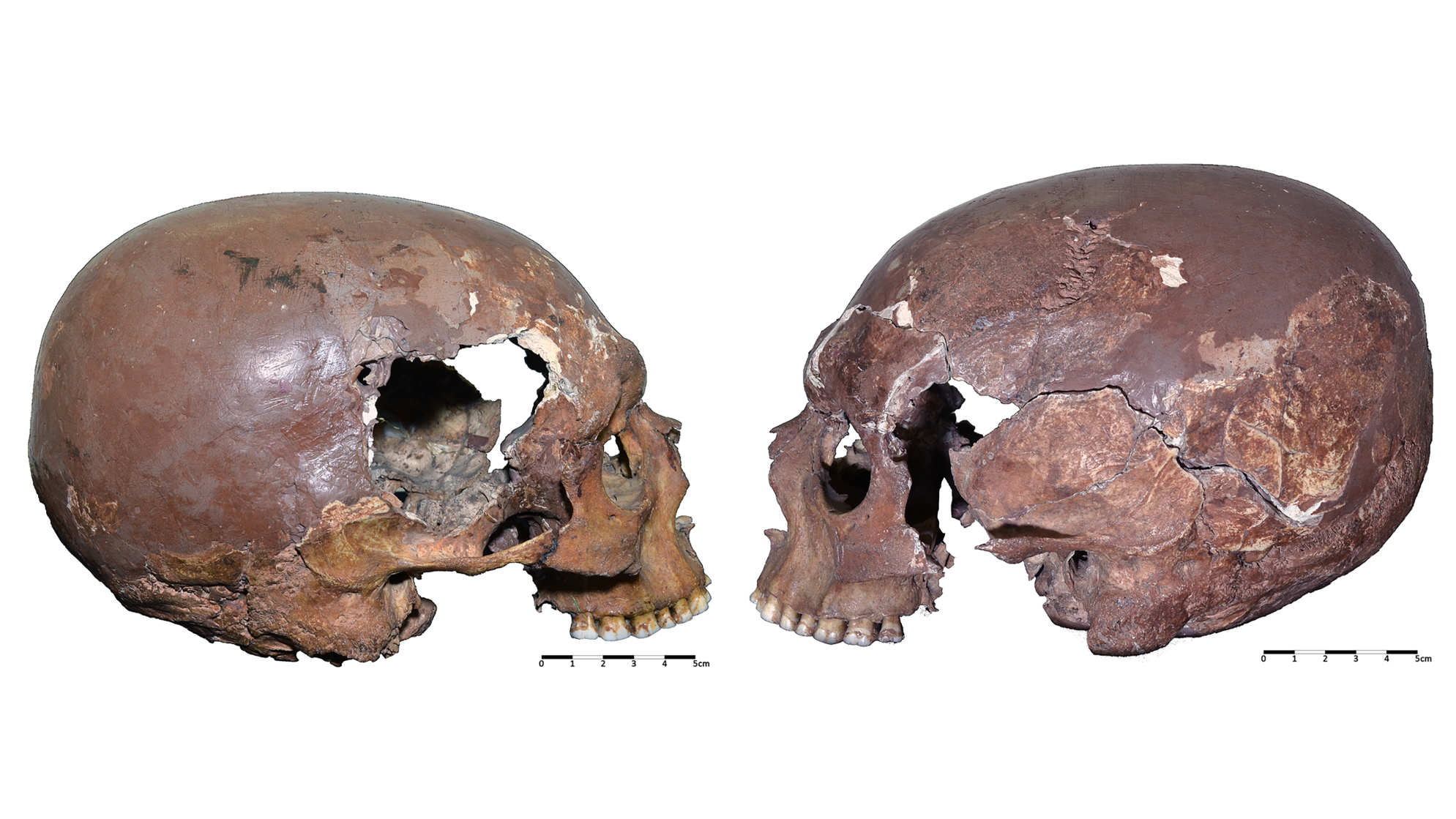 Two side views of a broken and undoed human skull