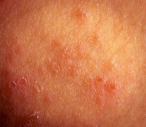 Plagued by a summer rash? How to tell if it's heat rash or