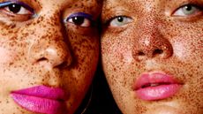 Two women with freckles and pigmentation - skin pigmentation