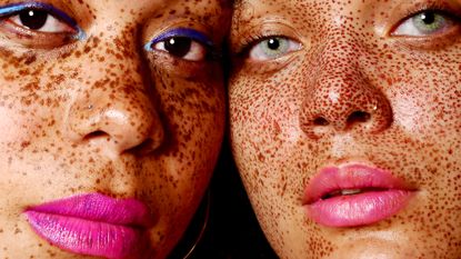 Two women with freckles and pigmentation - skin pigmentation