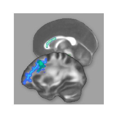 brain regions that changed after training for the lsat.