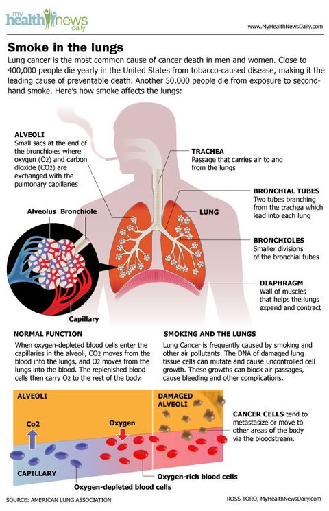Lung Cancer Signs Symptoms Types Treatment Live Science