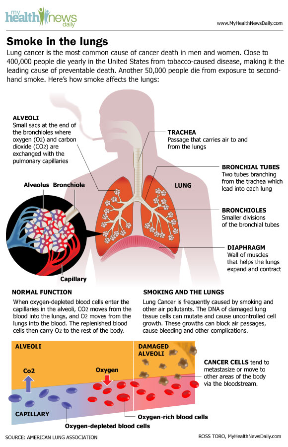 Lung Cancer Signs, Symptoms, Types & Treatment Live Science