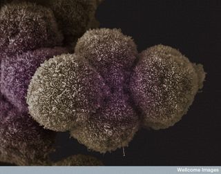 Pancreatic cancer cells.