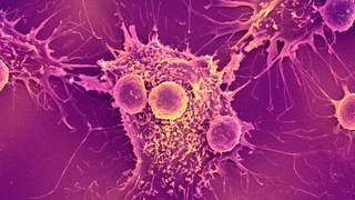 T lymphocytes and cancer cell. Coloured scanning electron micrograph (SEM) of T lymphocyte cells (smaller round cells) attached to a cancer cell.