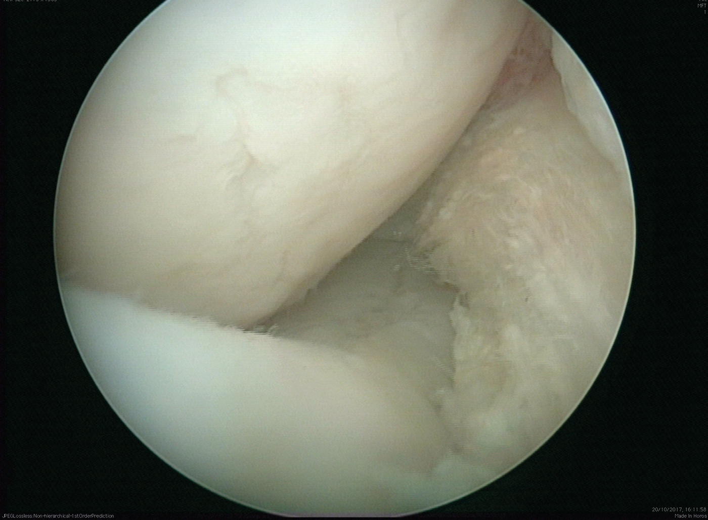 HAH299.vet_.medial_meniscus_tear_after_debridement_free_content_comm.jpg