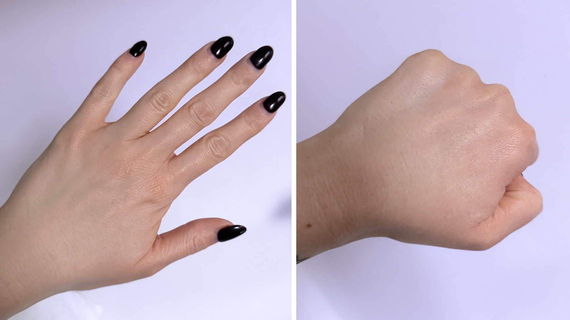 Lucy's hands one month after her final session of polynucleotides for hands