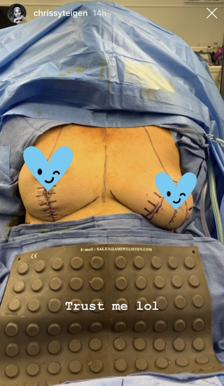 chrissy teigen breast implant removal surgery instagram