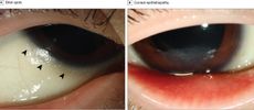 vitamin a defiency, jama