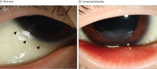 vitamin a defiency, jama