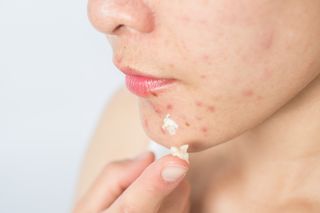 A close up of a woman applying acne cream to her chin