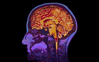 An MRI showing the brain.