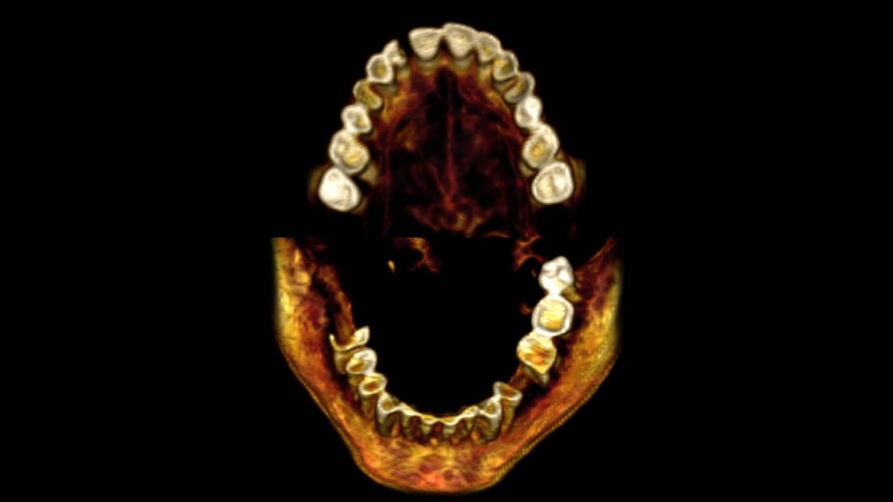 CT scan of the mummy teeth showing that she has lost a few teeth at the time of death