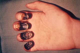 This 1977 image shows the necrotic flesh that gave the Black Death its name. This symptom is known as acral gangrene.