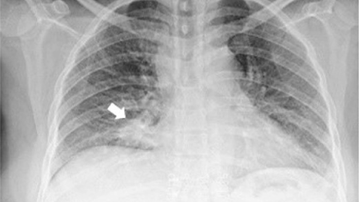 Black and white x-ray image of the patient's lungs with a white arrow pointing to a cancerous lesion in their right lung