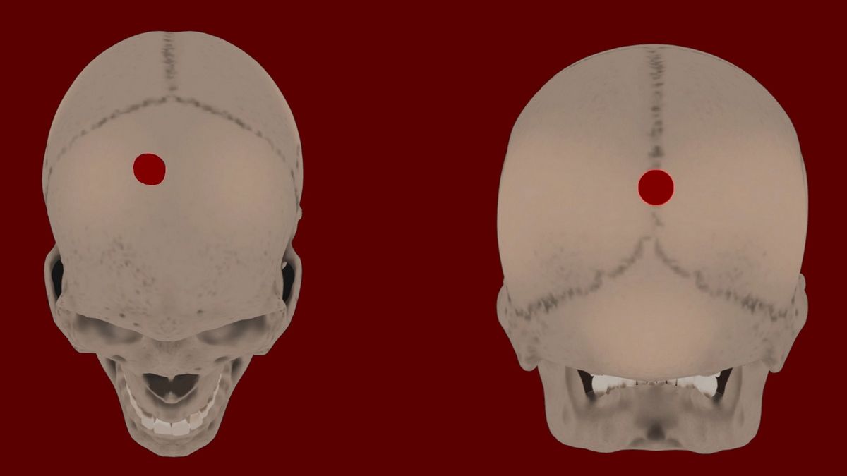 The computerized images of two skulls at different angles, with drilled holes marked at the top of one skull&#039;s image and at the front of the other skull&#039;s image.