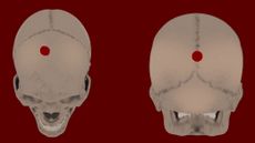 The computerized images of two skulls at different angles, with drilled holes marked at the top of one skull's image and at the front of the other skull's image.