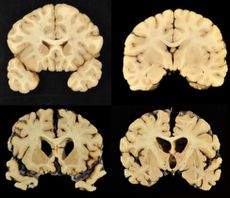 Images of the normal human brain and a brain with CTE. 