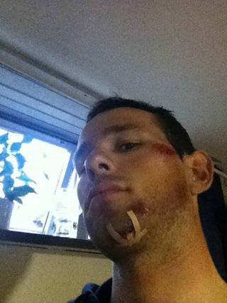 Alex Rasmussen (Gamin-Barracuda) shows off the stitches in his chin