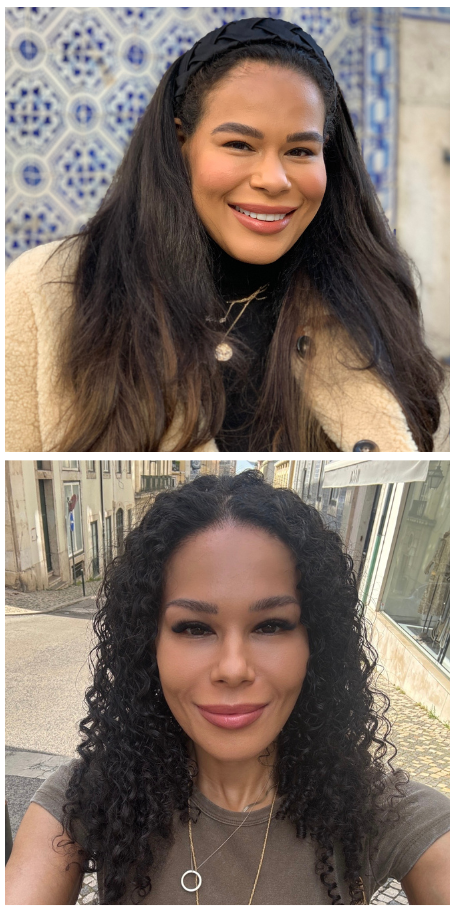 Traction Alopecia before &amp;amp; after