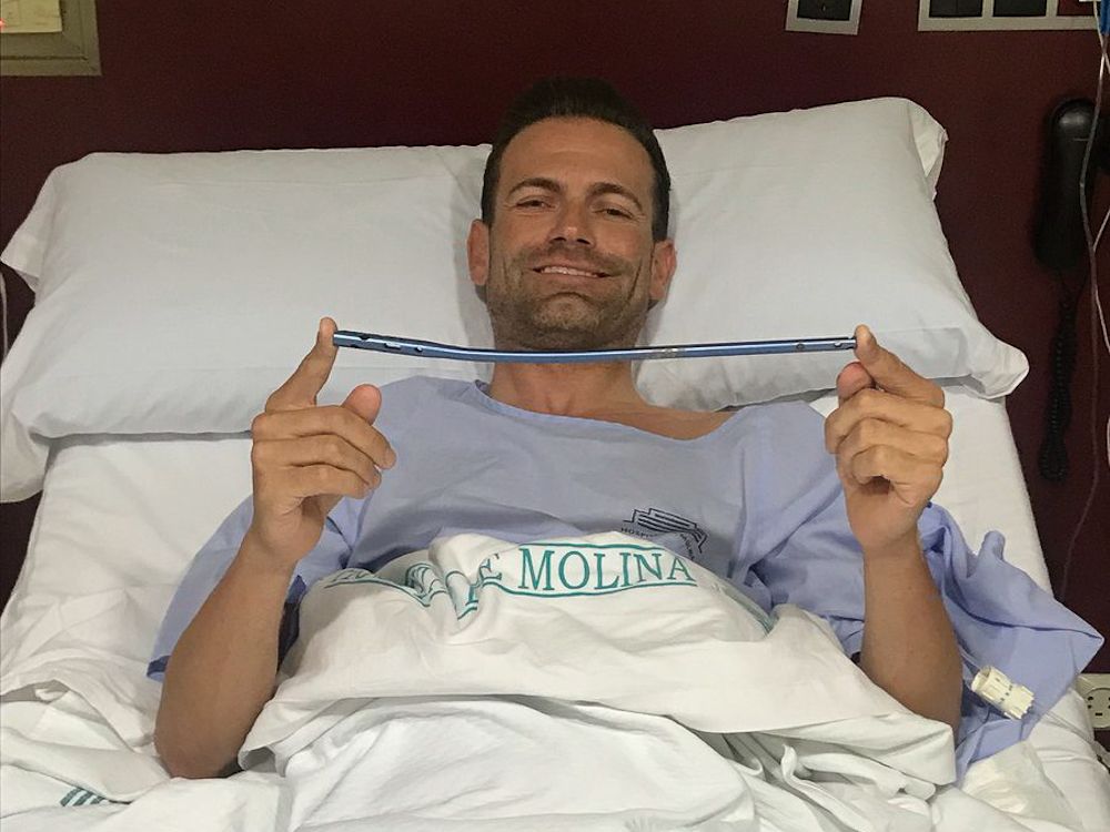Jose Joaquin Rojas shows off the hardware that doctors removed from his leg