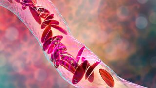 3d illustration of sickle-shape blood cells flowing through a blood vessel