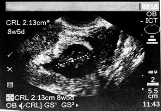 8-week old embryo ultrasound