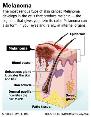 Melanoma is the most serious type of skin cancer. Learn more about melanoma at MyHealthNewsDaily.com.
