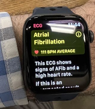 Photo of an Apple watch detecting Atrial Fibrillation