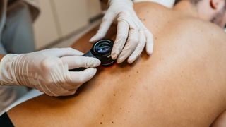 the gloved hands of a dermatologists hold a small magnifying device up to the moles and birthmarks on a patient&#039;s back. The male patient is lying face down on an exam table.